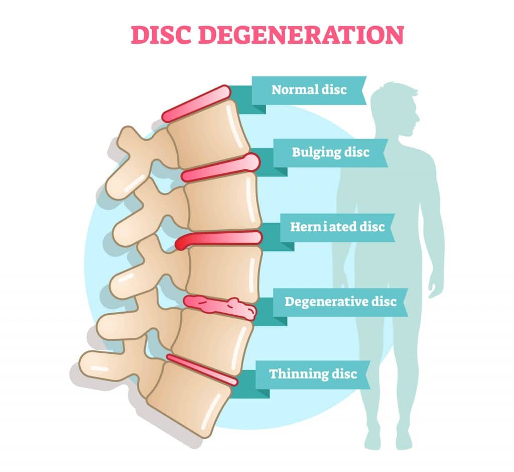 Is a Heating Pad Good for a Herniated Disc?