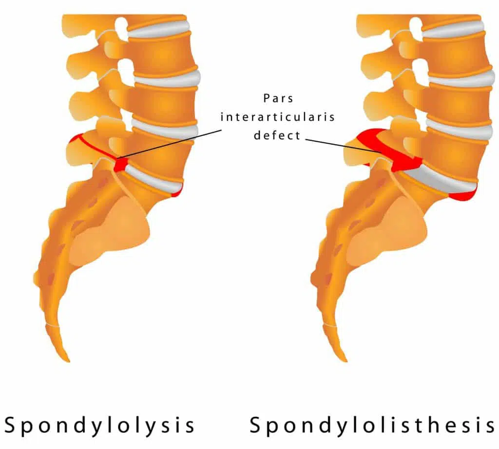 Spondylolysis Vs Spondylolisthesis