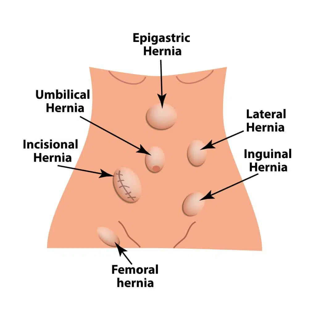 Types of Hernia in Adults | Rolling Hills Medical