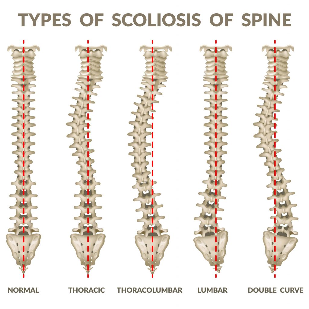 Scoliosis Types