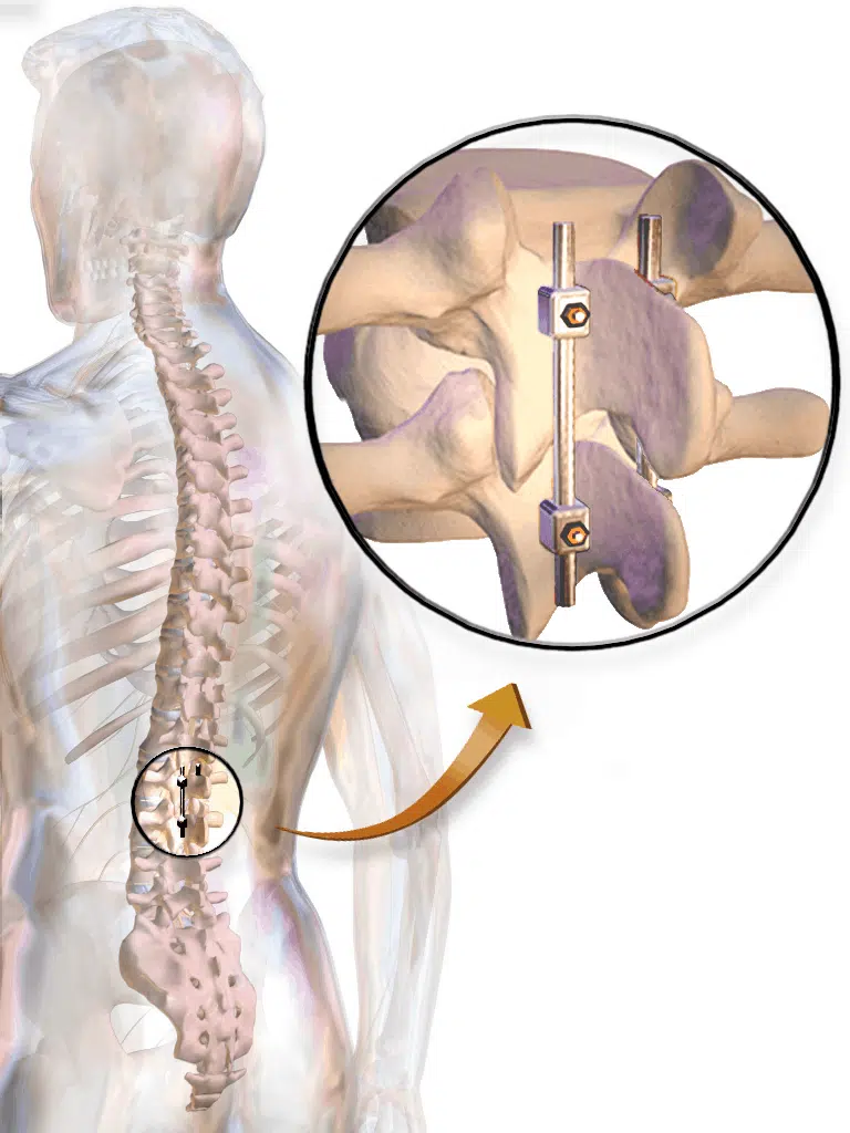 Fusion surgery for degenerative disc disorder