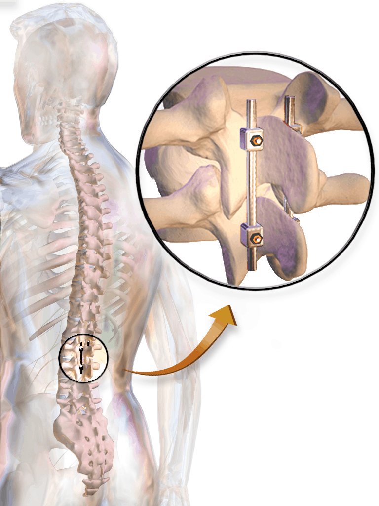 Spine fusion surgery Torrance