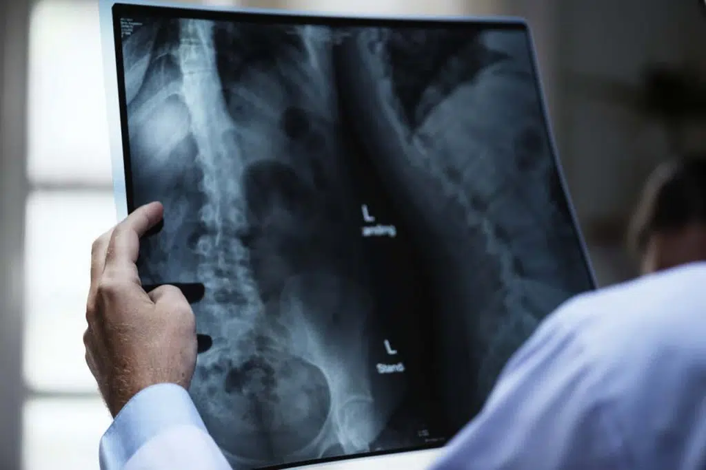 Surgical Spinal Cord Stimulation Orange County