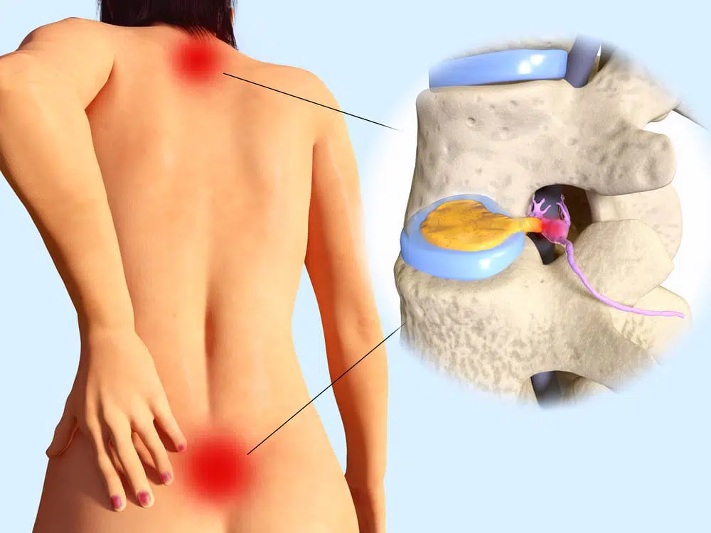 Animation of a herniated disc