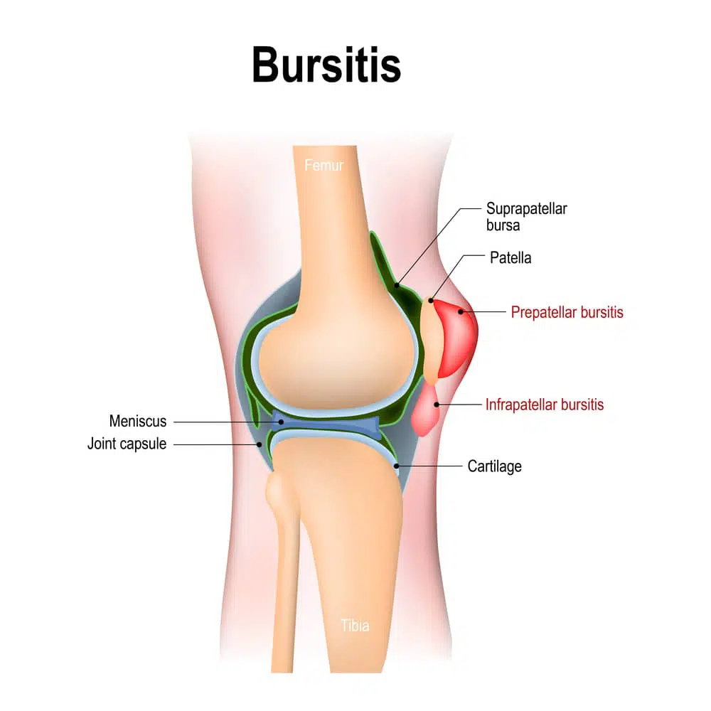 Knee bursitis diagram for treatment in Torrance.