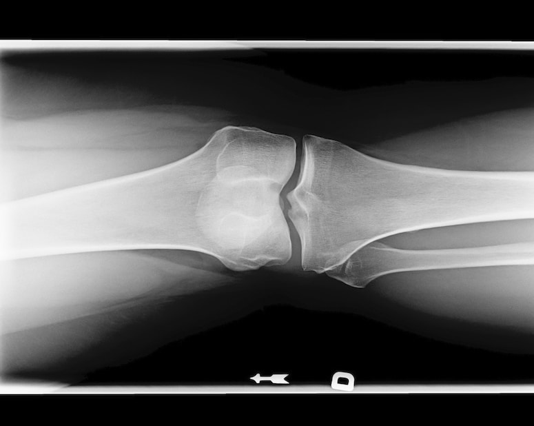 x-ray image of a patients knee