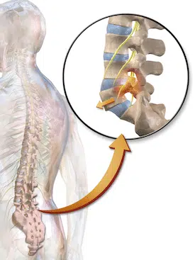 Animation of human spine with Spondylolisthesis