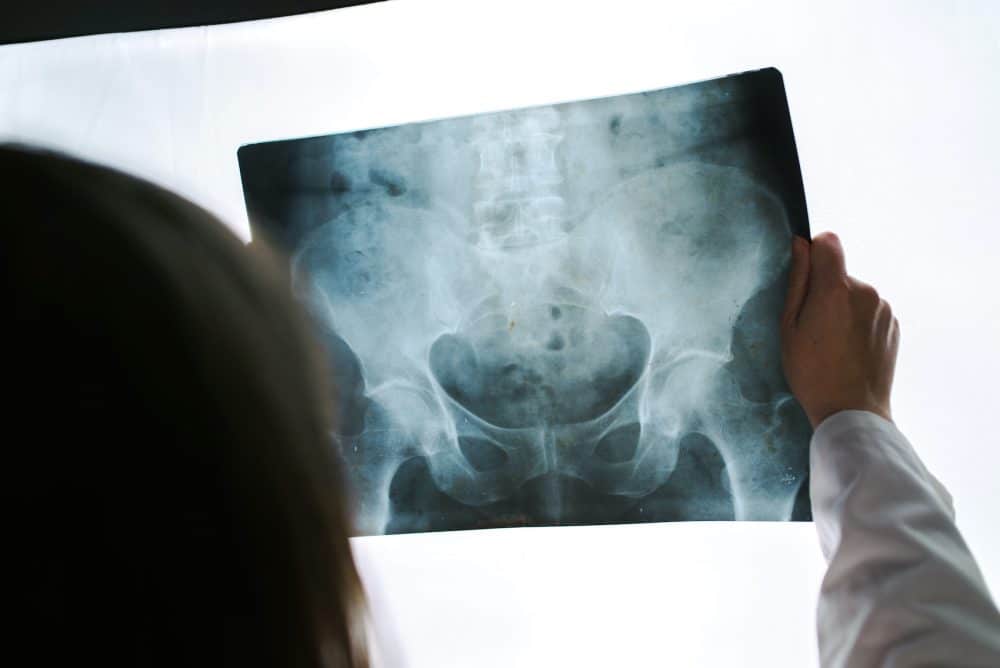 doctor holding an x-ray image of a patients hip