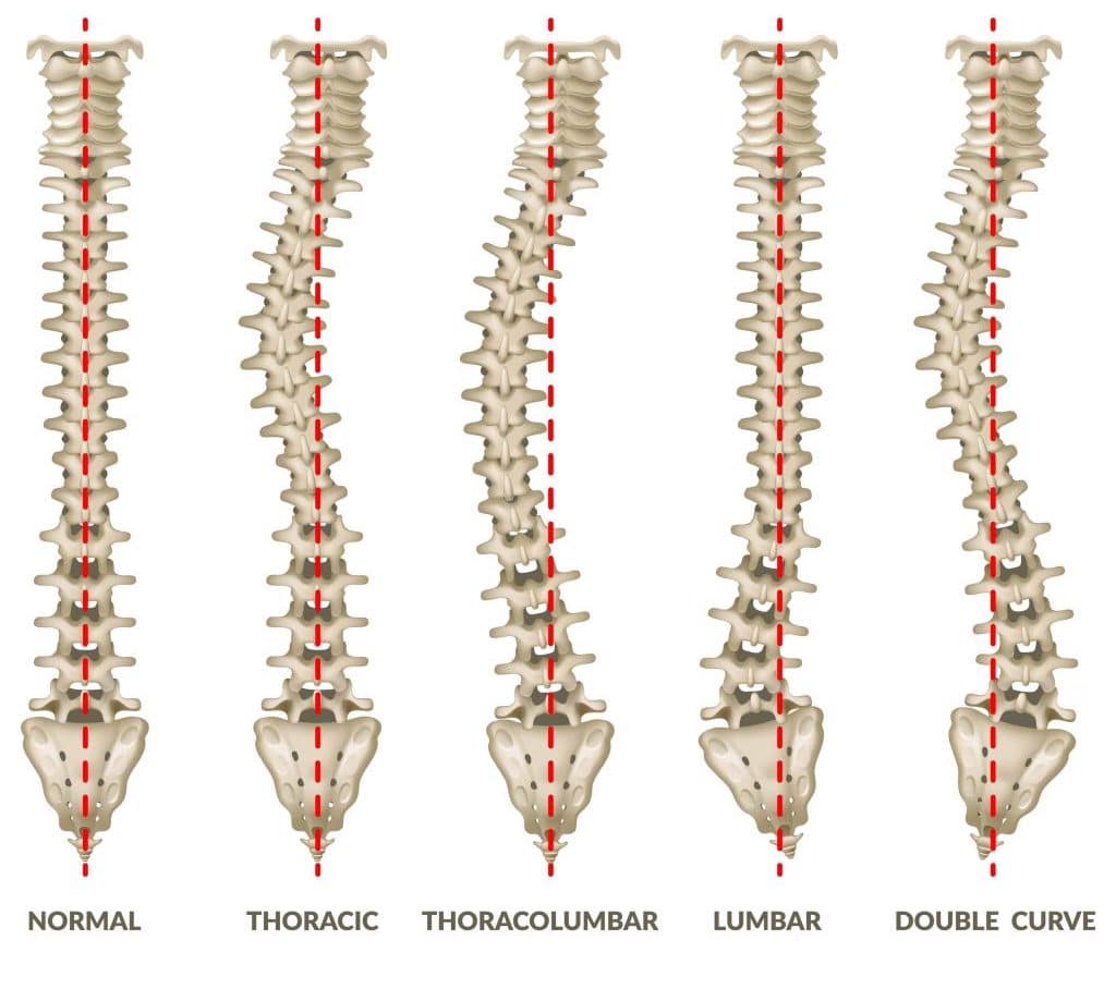 What Are The Different Types of Scoliosis? | Rolling Hills Medical