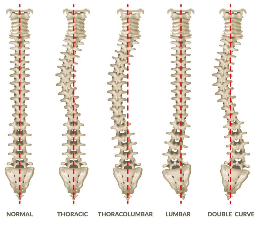 scoliosis types