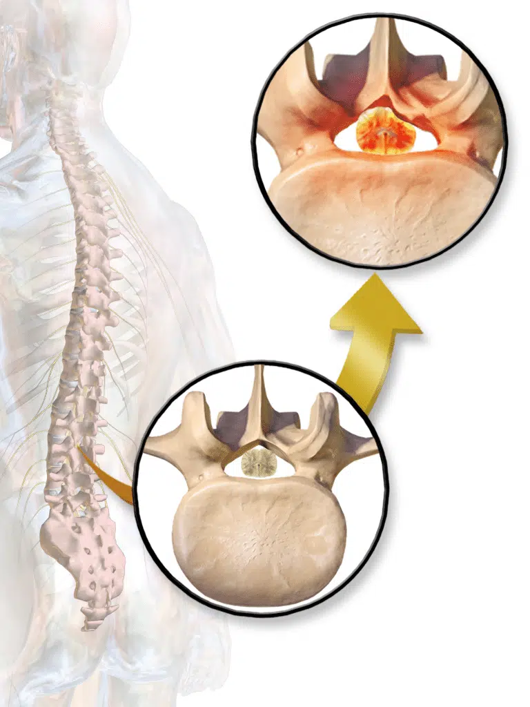 3d figure of a skeleton with spinal stenosis