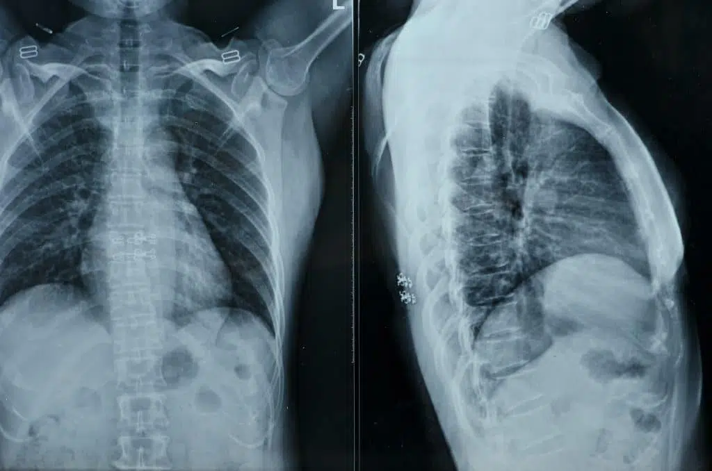 x-ray image of a patients upper back