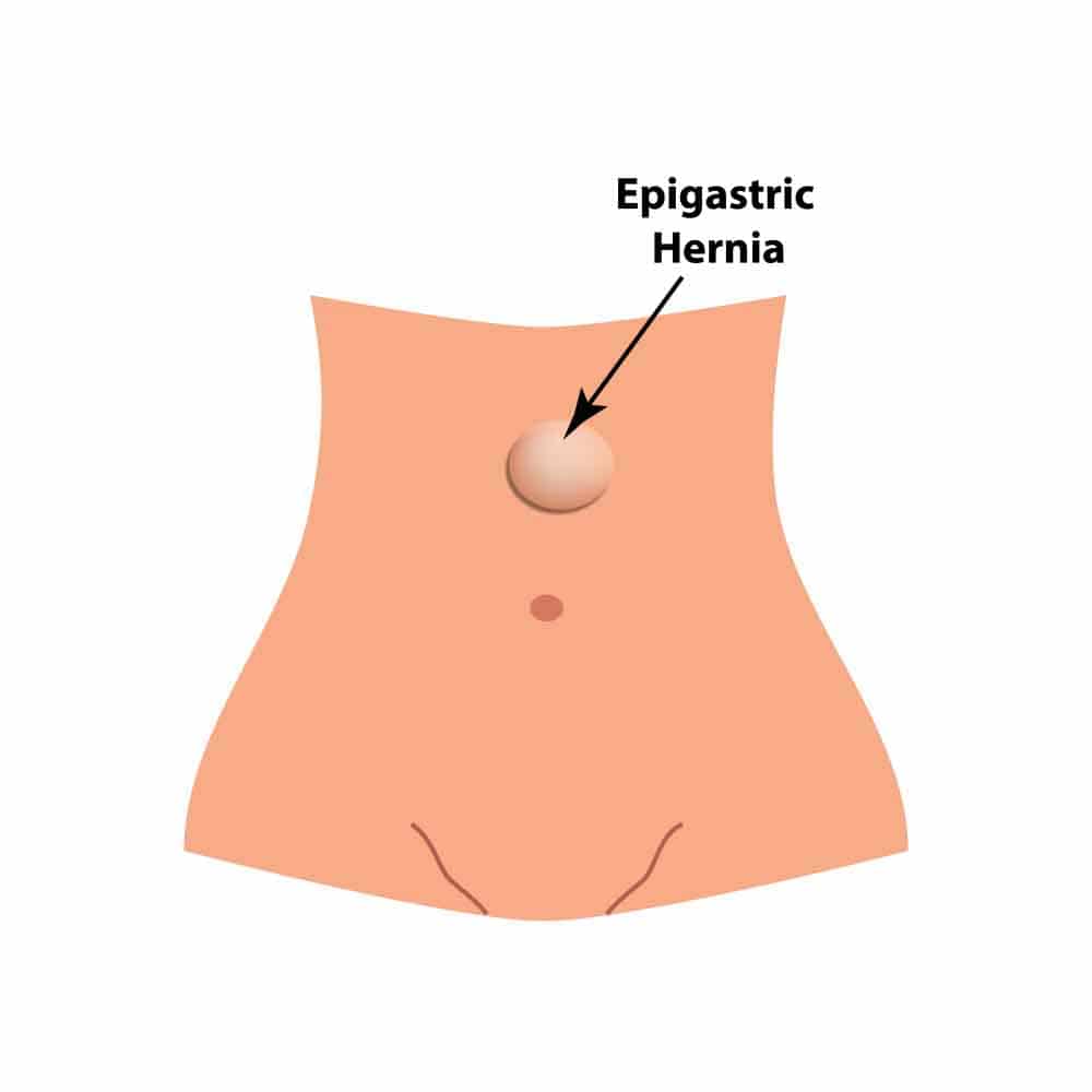 Epigastric Hernia diagram