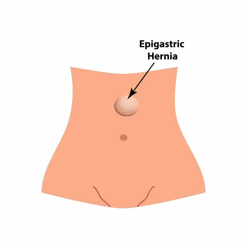 Types of Hernia in Adults