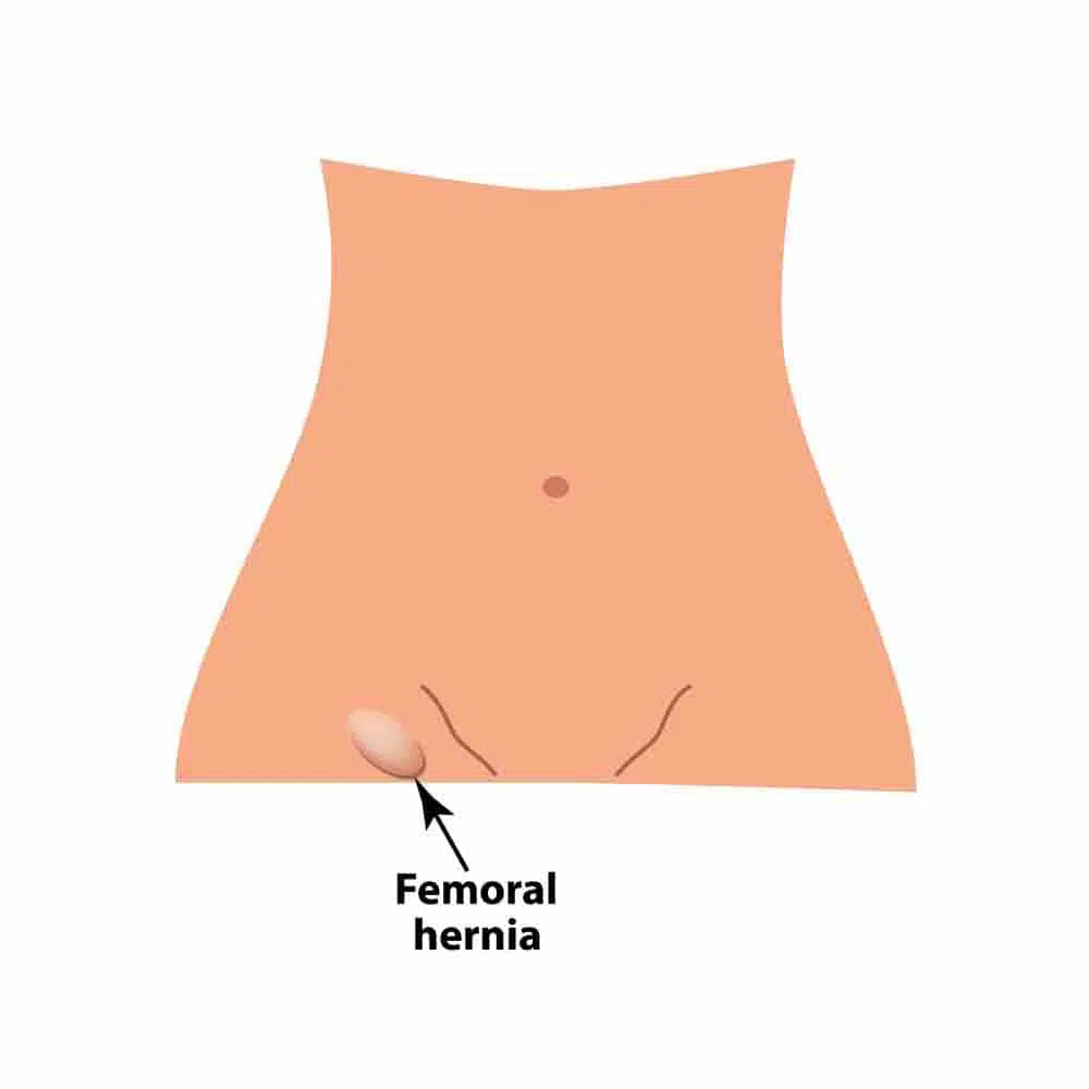 Diagram of Femoral Hernias.