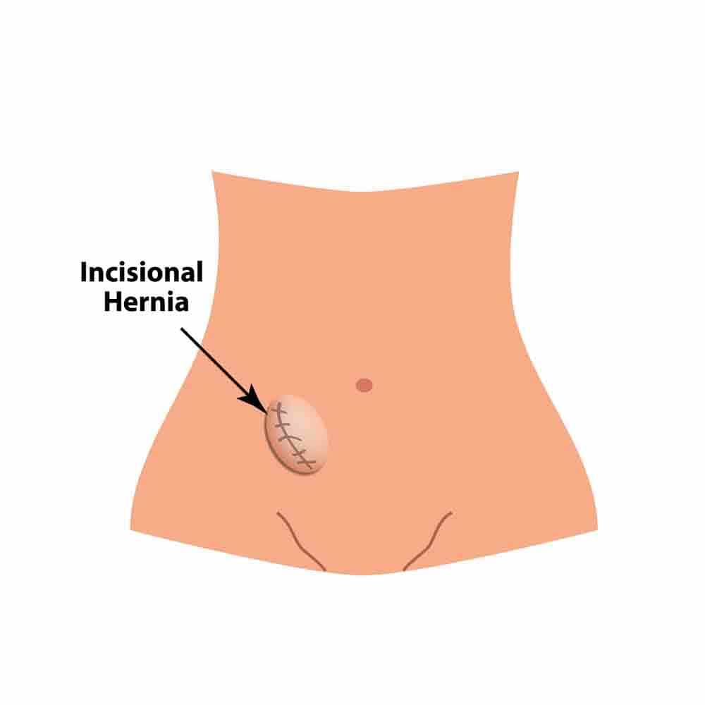 Image of Incisional Hernia