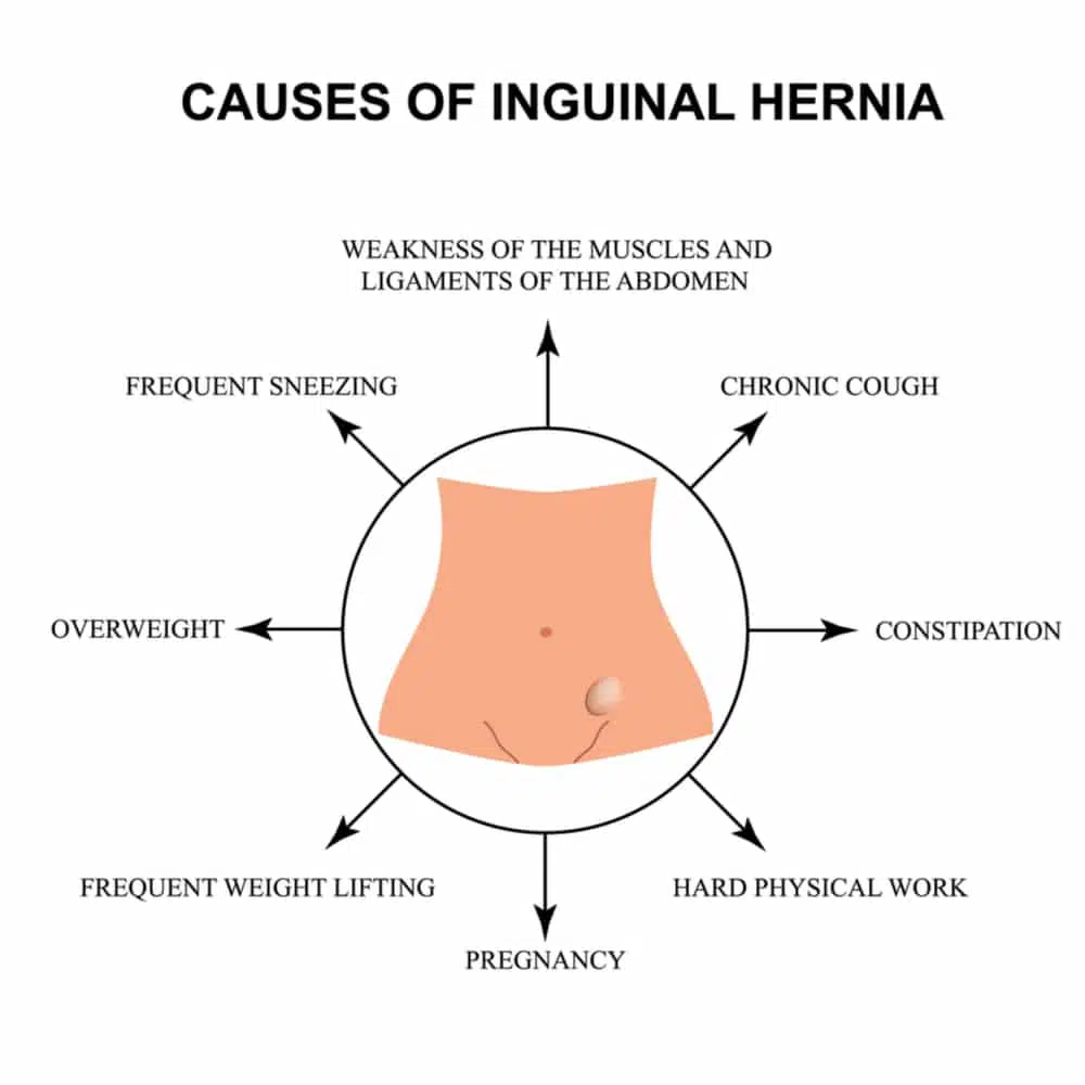 Types of Hernia in Adults