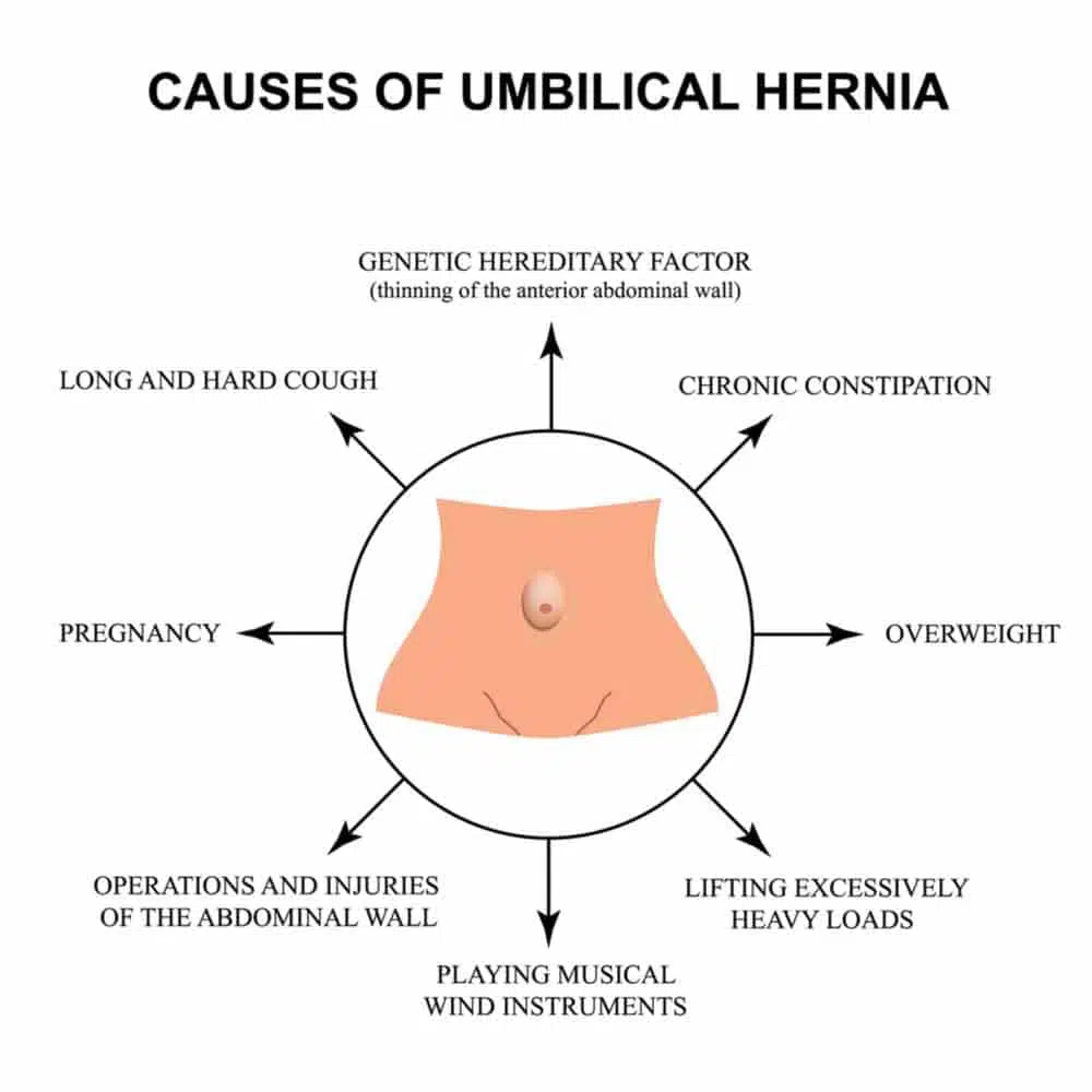 Diagram of Umbilical Hernias.