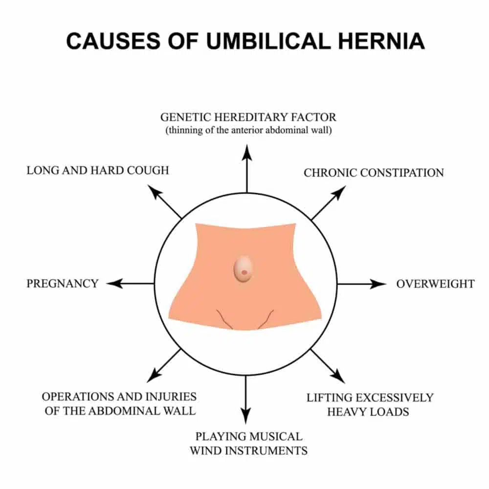 Umbilical Hernia Causes and Treatment