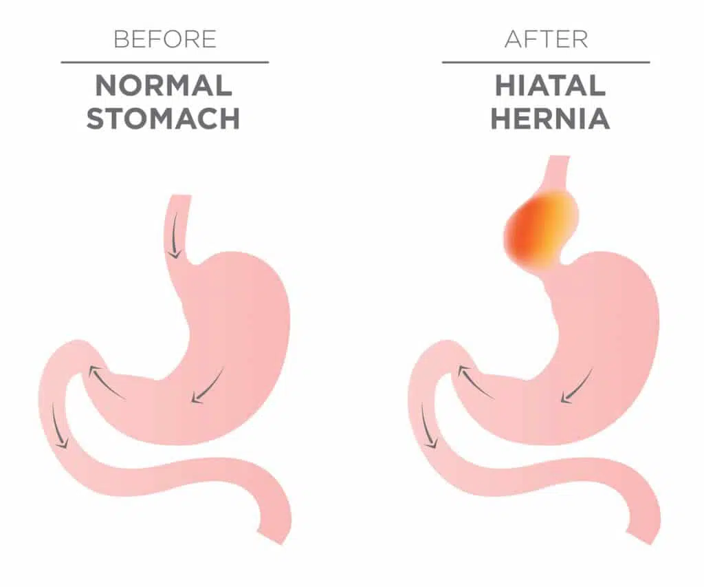Diagram of a Normal Stomach vs Hiatal Hernia.