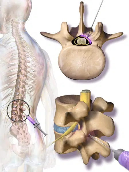 Epidural Steroid Injections offered at Rolling Hills Medical.