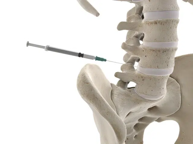 3D illustration of skeletal spine and cervical facet injection to the affected disc